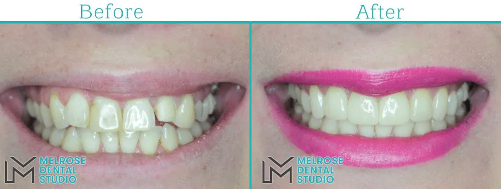 Smile makeover with porcelain veneers at Melrose Dental Studio, before and after, case 5